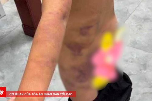 Nghi vấn phụ huynh đánh bầm tím nhóm học sinh do hút thuốc lá