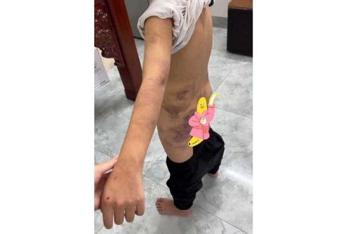 Làm rõ nghi vấn bé trai bị bạo hành ở Hưng Yên