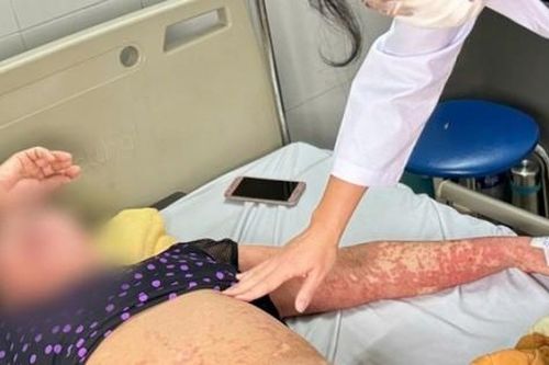 Người phụ nữ có men gan tăng gấp 8 lần, mặt biến dạng vì lý do này