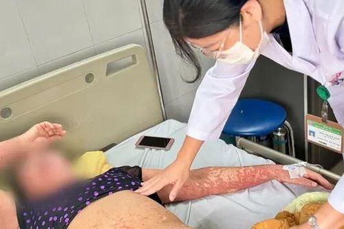 Cụ bà biến dạng khuôn mặt vì dị ứng thuốc nặng
