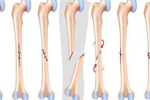Gãy xương: Nguyên nhân, triệu chứng, cách phòng tránh và điều trị