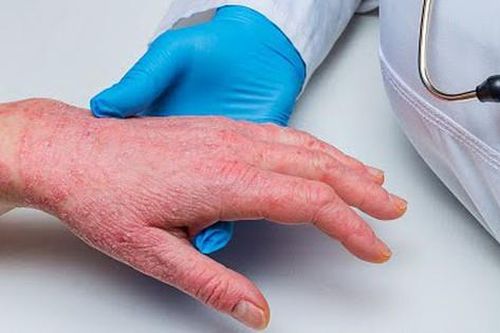 Thuốc điều trị vảy nến ở người cao tuổi