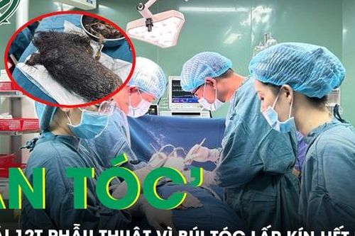 Kinh hoàng: Bé gái 12 tuổi 'ăn' gần 1kg tóc, lấp kín dạ dày