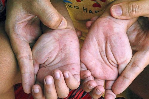 Thời tiết nồm ẩm, số mắc tay chân miệng tại Hà Nội tăng gần 1,4 lần trong tuần