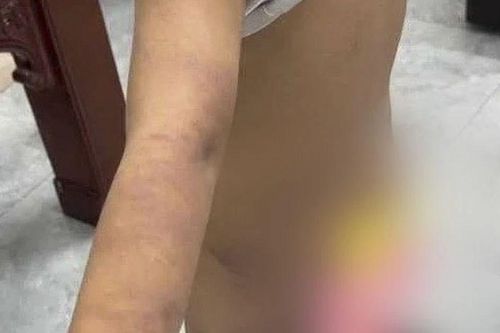 Răn đe không cho con trai dùng thuốc lá, người bố dùng ống nhựa đánh nhóm trẻ tại cơ sở karaoke