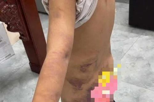 Nghi vấn bé trai lớp 6 bị người lớn bạo hành, trên cơ thể có nhiều vết bầm tím