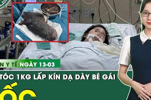 Bản tin Y tế 13/3: Búi tóc khổng lồ gần 1 kg lấp kín dạ dày bé gái 12 tuổi