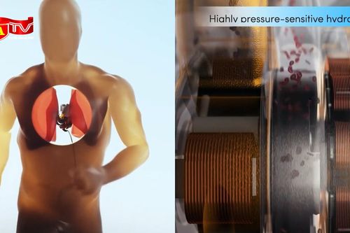 Người đầu tiên trên thế giới sống được 100 ngày với trái tim nhân tạo hoàn toàn