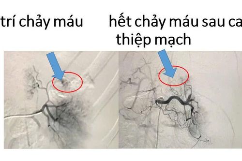 Trẻ 5 tuổi bị vỡ lách do ngồi trước xe máy cha chở gặp tai nạn
