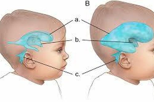 Bé bị não úng thủy có sức khỏe và tuổi thọ như thế nào?