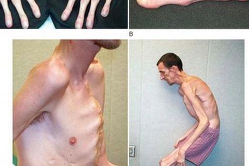 Hội chứng Marfan: Nguyên nhân, biểu hiện, cách điều trị và phòng bệnh