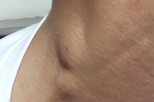 Lao hạch: Nguyên nhân, triệu chứng, phòng ngừa và điều trị