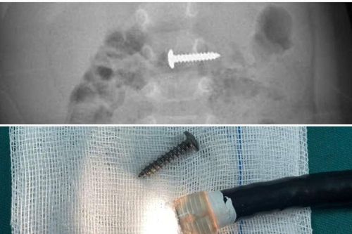 Gắp thành công chiếc đinh vít ra khỏi bụng bệnh nhi 34 tháng tuổi