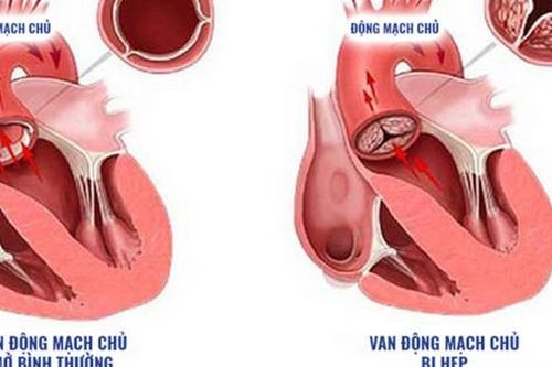 Hẹp van động mạch chủ: Nguyên nhân, triệu chứng, cách điều trị và dự phòng