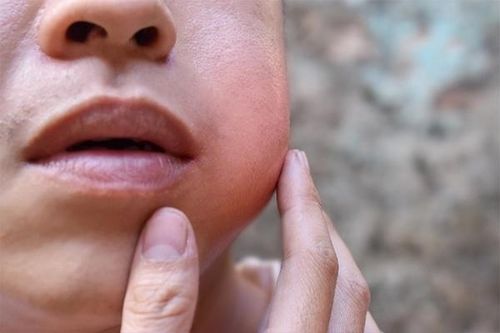 Biến chứng nguy hiểm của bệnh quai bị