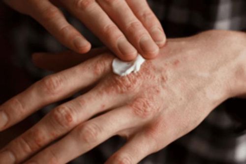 4 lưu ý dùng thuốc giúp kiểm soát bệnh vảy nến thành công