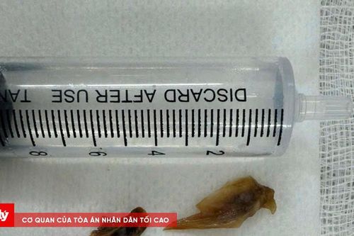 Lấy thành công lấy 2 mảnh xương bị bỏ quên trong phổi