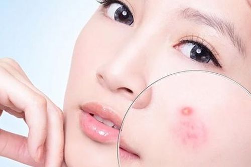 Sản phẩm trị mụn của thương hiệu La Roche Posay bị thu hồi ở Mỹ khiến nhiều tín đồ làm đẹp ở Việt Nam hoang mang