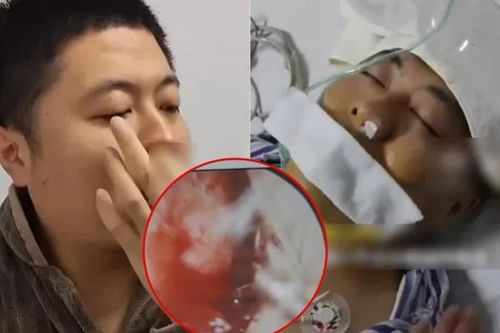 Mảnh xương vịt nằm trong phổi suốt 2 năm gây biến chứng nặng