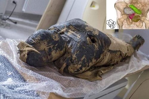 Sững sờ sự thật về xác ướp mang thai, chết vì ung thư?