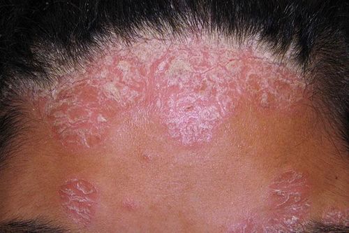 Thuốc nào trị bệnh vảy nến da đầu?