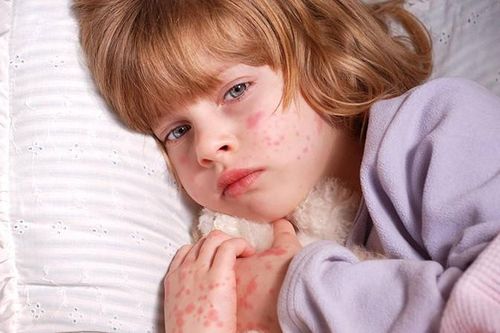 Mề đay ở trẻ em phải làm sao?