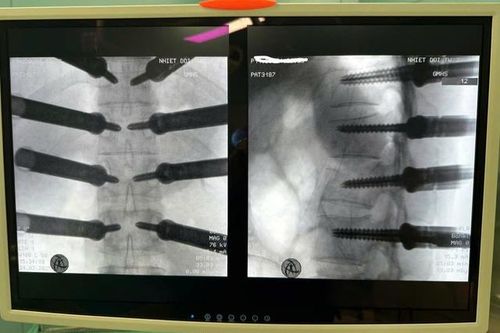 Cứu cột sống cho thanh niên ngã từ độ cao 4 m