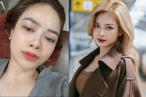 Dương Hoàng Yến bị liệt dây thần kinh số 7