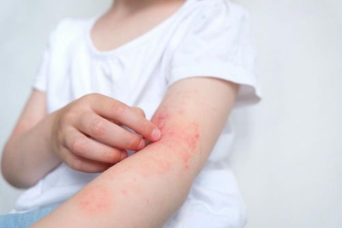 Viêm da dị ứng là bệnh gì?
