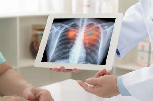 Căn bệnh khiến người đàn ông có 72 lỗ thủng trong phổi, mất khi 28 tuổi