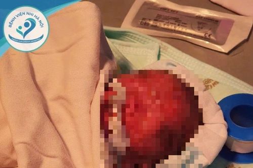 Sơ sinh bị đẻ rơi nặng 900g hồi phục sự sống kỳ diệu trước 'cửa tử'