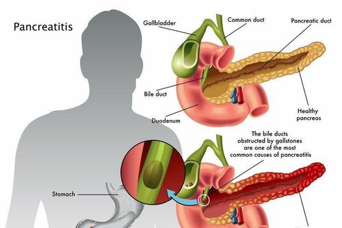 Sữa bổ dưỡng nhưng những người này nên hạn chế uống