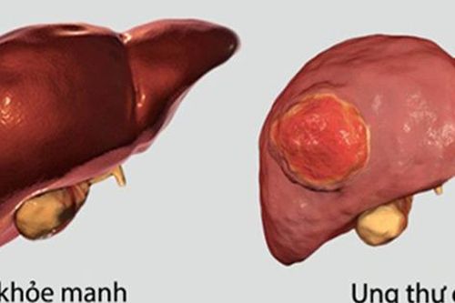 Đi khám vì mệt mỏi, đau tức ngực, người đàn ông 60 tuổi bất ngờ phát hiện ung thư gan