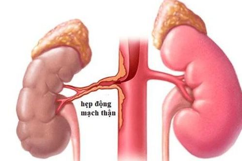 Hẹp động mạch thận: Nguyên nhân, biểu hiện, cách điều trị và phòng bệnh