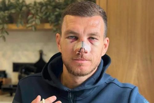 Mặt Dzeko bầm dập