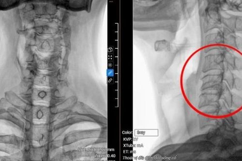 Hỏng ba đốt sống cổ do... cúi đầu dùng điện thoại 8 giờ/ ngày