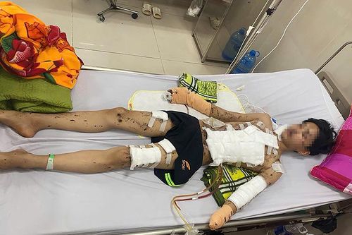 Pháo tự chế phát nổ, nam sinh mất bàn tay và tổn thương nghiêm trọng