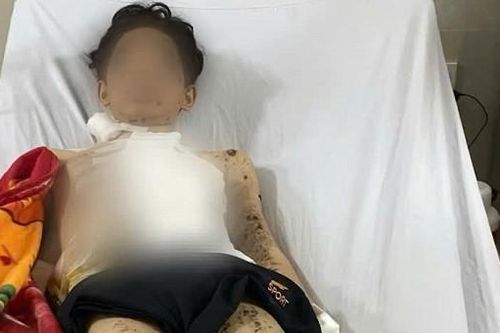 Tự chế pháo nổ, nam sinh bị đa chấn thương và mất một bàn tay