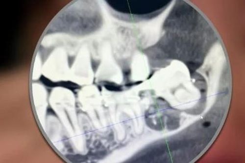 Bị nhổ nhầm răng khôn, người phụ nữ làm một việc khiến ai nấy đều xót xa