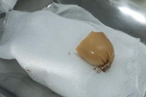 Đang ăn xúc xích, bé gái 13 tuổi phải đi cấp cứu vì lý do này