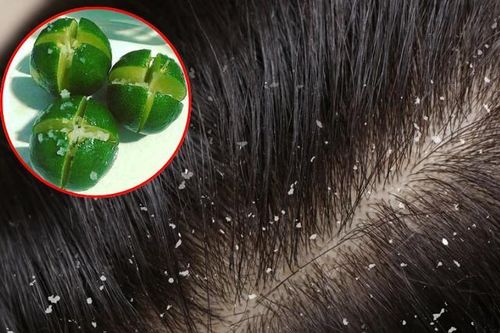 5 cách để hết gàu nhanh chóng
