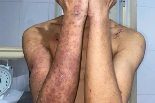 Gánh hậu quả vì liều lĩnh đắp kiến ba khoang chữa ngứa