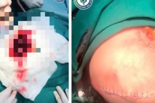 Bé trai 6 tháng tuổi xuất huyết não, hôn mê vì đột quỵ