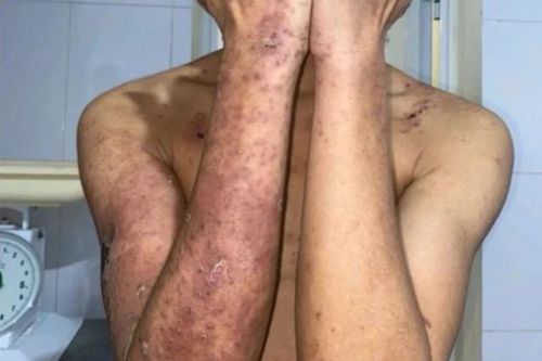 Đắp kiến ba khoang chữa ngứa, nam thanh niên gánh hậu quả