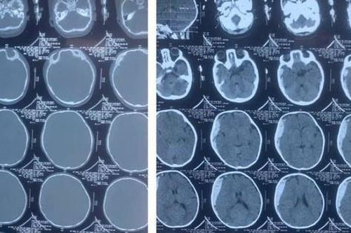 Bé 11 tháng tuổi đang chơi đùa bỗng thét lên 1 tiếng rồi hôn mê nguyên nhân khiến ai cũng bất ngờ