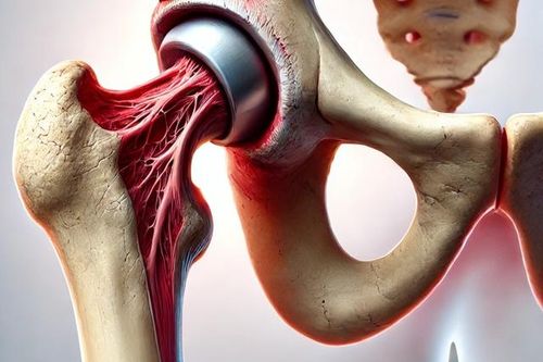 Hoại tử vô mạch: Nguyên nhân, triệu chứng, điều trị và cách phòng ngừa