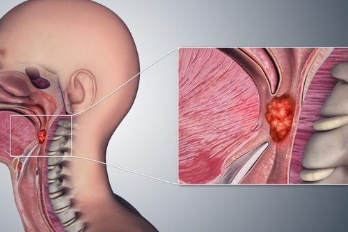 Các dấu hiệu, nguyên nhân và yếu tố nguy cơ gây ung thư vòm hầu