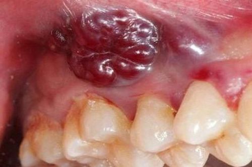 8 dấu hiệu cảnh báo ung thư khoang miệng