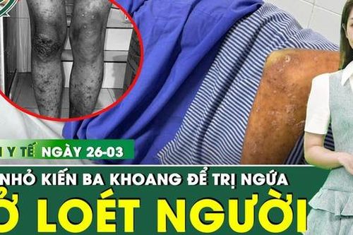 Bản tin Y tế 26/3: Chữa ngứa bằng 40 con kiến ba khoang, nam thanh niên lở loét toàn thân