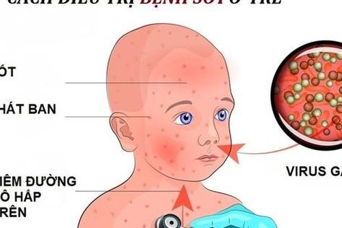 Dùng thuốc điều trị sởi và viêm não do bệnh sởi